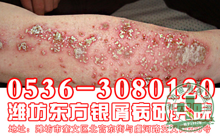 银屑病治疗的偏方使用要注意什么?