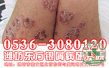 脓疱型银屑病的治疗要注意什么问题?