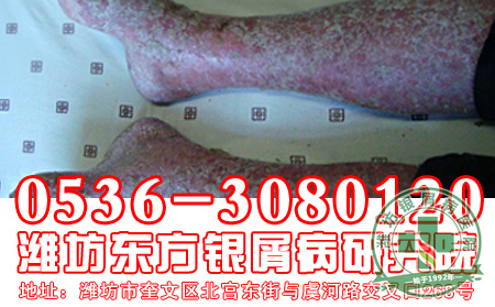 红皮型银屑病的症状有什么？