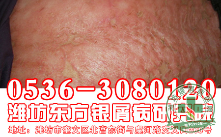 寻常型银屑病发病后会出现的症状是怎样的？
