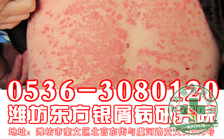 银屑病防复发应该做到哪些？