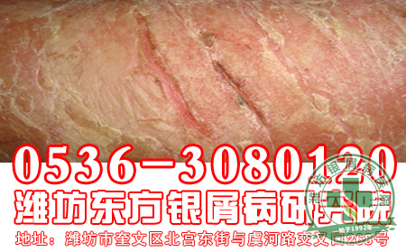 对于银屑病的传染,患者要注意什么