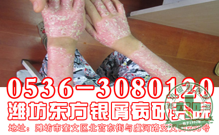 银屑病患者怎样保健护理是非常重要的