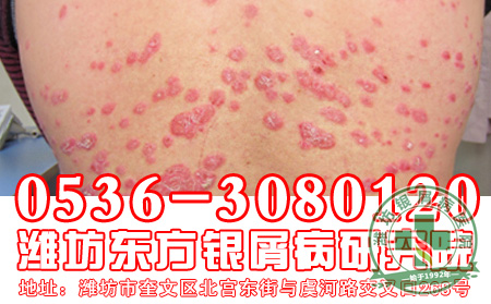 秋季的银屑病护理要注意的问题有什么？