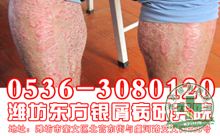 银屑病患者发病后会表现出来的症状是怎样的