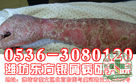 偏方治疗银屑病到底有没有效果呢？