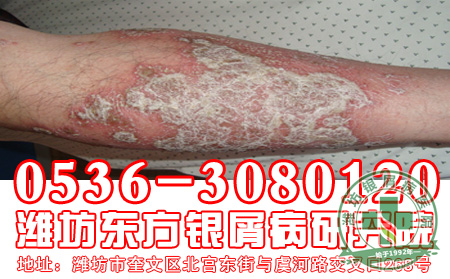 银屑病的复发对于患者来说要注意什么