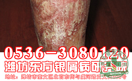 银屑病的治疗应该注意什么心理问题?