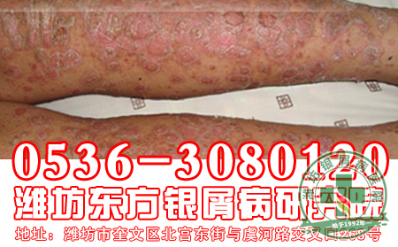 患者对于寻常型银屑病的发病表现要注意什么?