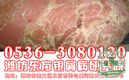 银屑病真的会传染你对此有什么了解