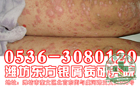 银屑病患者对于饮食要注意什么问题?