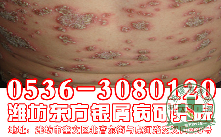 哪些因素会导致银屑病的发病和加重