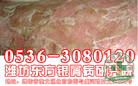 银屑病的治疗工作要怎样注意偏方使用?