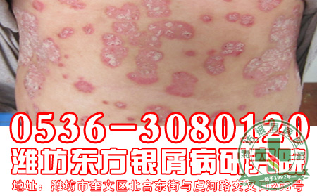 牛皮癣的治疗问题,患者应该怎样注意用药