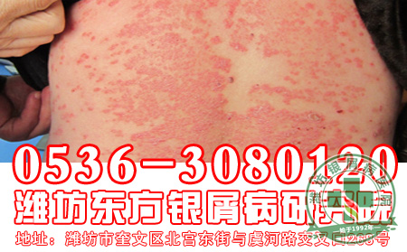 秋冬季节，患者应该怎样护理避免牛皮癣加重
