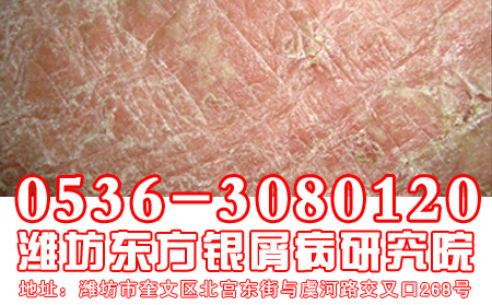 患者在考虑治疗银屑病的时候应该注意到哪几点