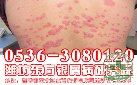 银屑病患者的饮食工作该怎样做