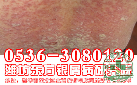 银屑病患者在选择治疗的时候注意做好哪几点的防护工作