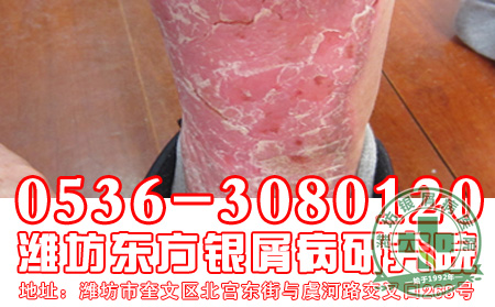 牛皮癣的偏方