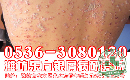 银屑病的发病患者要注意些什么
