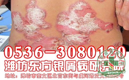 患者对于红皮型银屑病要注意什么