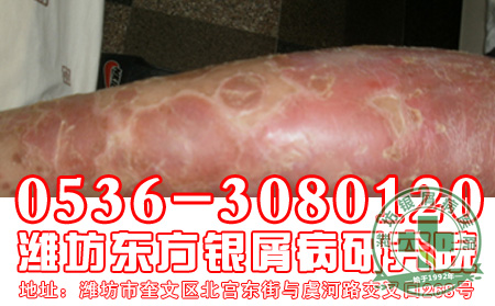 银屑病患者对于自己的发病应该知道什么