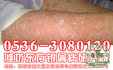 患者对于银屑病的