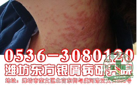 减少银屑病的复发，患者应该注意什么