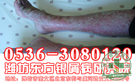 银屑病患者对于病情的治疗要注意什么问题