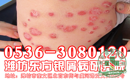 银屑病发病后患者应该注意知道什么