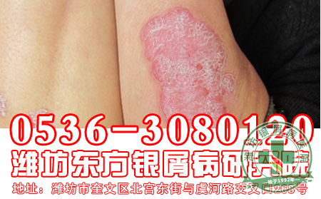 患者对于银屑病传染应该注意知道什