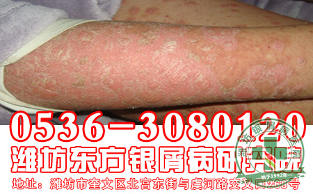 银屑病会因为很多原因复发，你知道原因吗