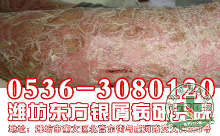 患者在选择治疗牛皮癣的时候要注意什么问题