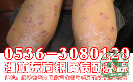 银屑病发病的原因和症状是怎样的