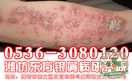关于银屑病的复发患者应该注意什么？