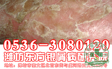 银屑病患者的饮食宜吃和忌口应该注意什么？