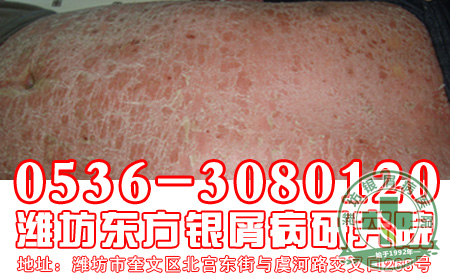 牛皮癣会给患者造成的危害有什
