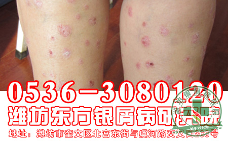 银屑病患者的饮食工作应该怎样做才好？