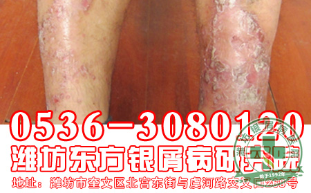 银屑病患者要怎样诊断自己的病情？