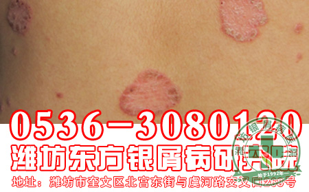 患者对于寻常型银屑病的治疗工作要做到哪些?
