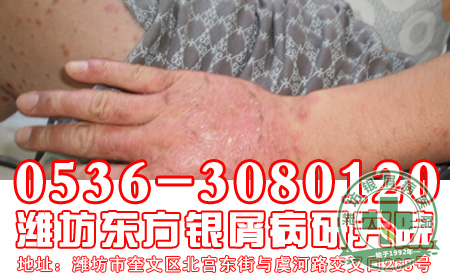 怎样做有助于减少银屑病的复发