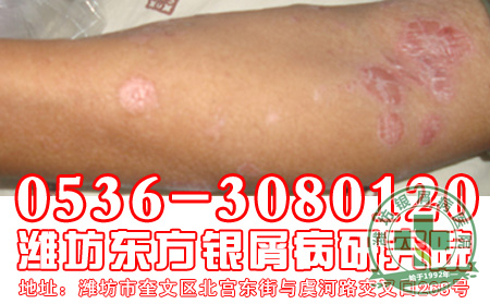 银屑病的治疗过程中用药要注意什么？