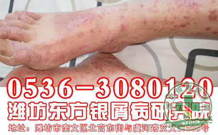 银屑病为什么会那么难以治疗？