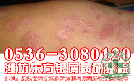 怎样做能减少银屑病的加重
