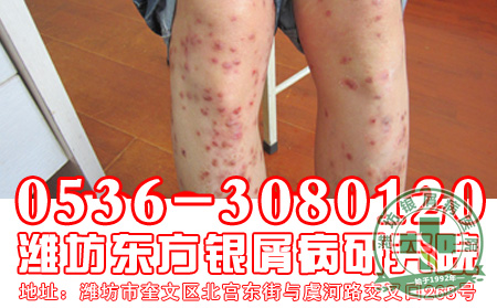 银屑病患者的病情会传染蔓延吗?