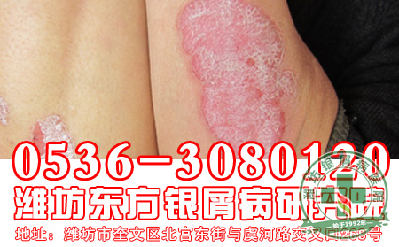 哪些食物适合银屑病患者食用?