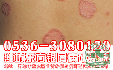 银屑病的治疗要怎样注意药物使用？