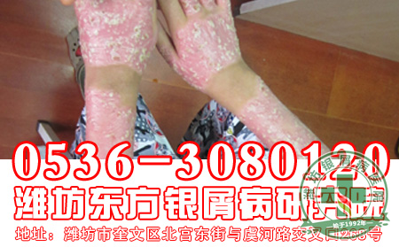 患者在秋季银屑病刚刚复发时应该怎样护理？