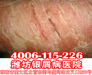银屑病为什么不要随便使用偏方?
