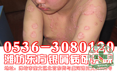 患者要注意做好哪些防护工作对于银屑病 重要